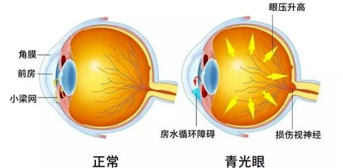 不可逆的 視力小偷 ,我們應該如何應對ta